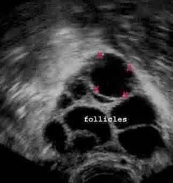 IVF FAQs IVF FAQs