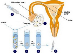 IVF Follicles