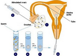 IVF Follicles IVF Follicles
