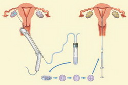 Treatment IVF